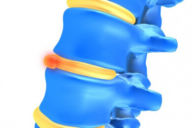 Können zukünftig Bio-Bandscheiben Rückenschmerzen lindern?