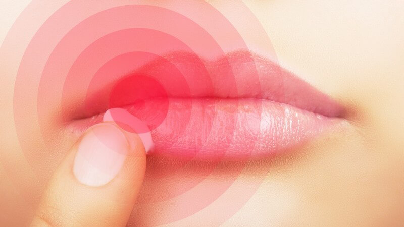 Frau tupft Creme auf Lippen zur Behandlung von Herpes