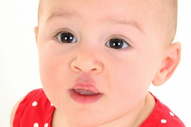 Der Storchenbiss - Behandlung mit Betablockern hilft Patienten eher als die Vergabe von Steroiden