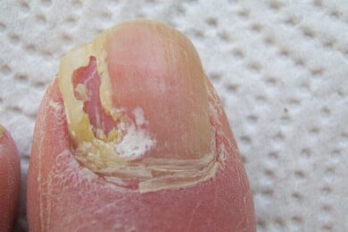 Zur Vorbeugung von Fuß- und Nagelpilz Fußspray nutzen