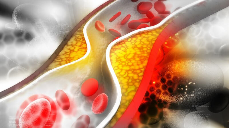 Graue 3-D-Grafik einer Cholesterin-Ablagerung in einer Arterie