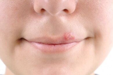 Lippenherpes kann auch durch Ekelgefühle ausgelöst werden