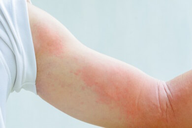 Stress als häufiger Auslöser von Hautproblemen