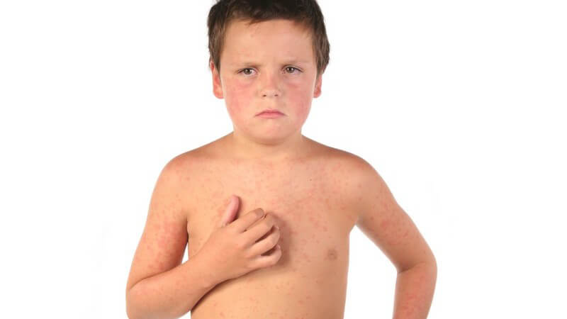 Kleiner trauriger Junge mit rotem Ausschlag auf Haut