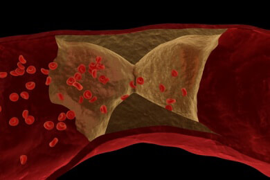 Soja-Eiweiß beugt Arteriosklerose vor