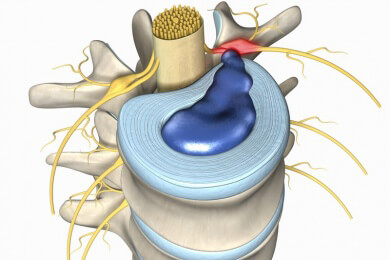 Herpesviren als Auslöser für einen Bandscheibenvorfall?