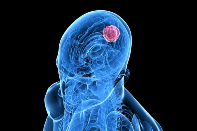 Mittel gegen Epilepsie hilft bei Hirntumoren