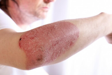 Psoriasis-Arthritis - die Verbindung beider Krankheiten wird häufig nicht erkannt