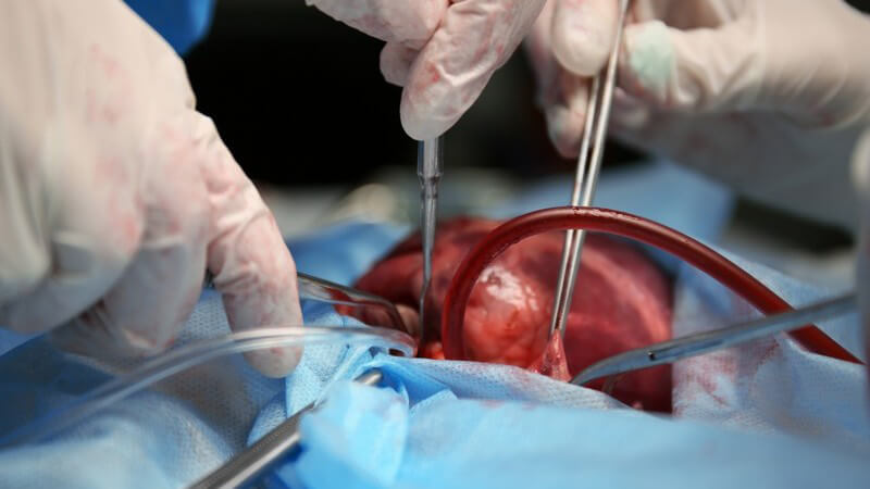 Mehrere Chirurgenhände bei der Operation an einem Herzen
