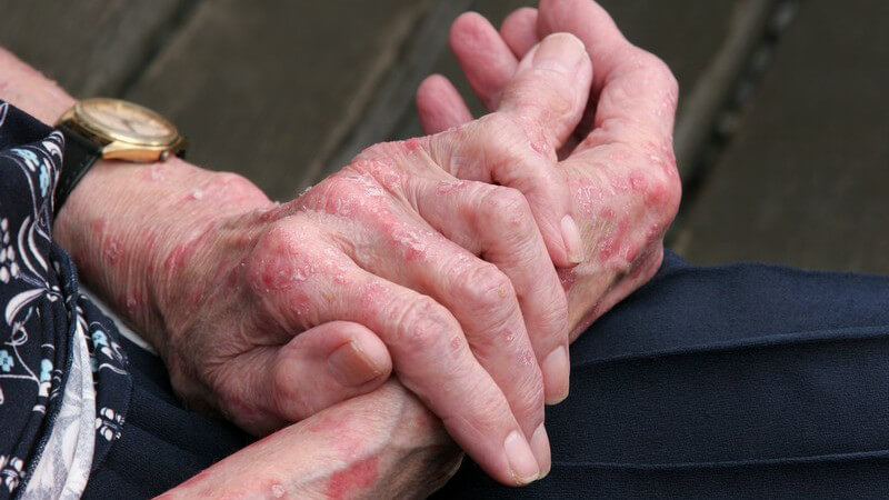 Hände eines alten Menschen mit Hautausschlag bzw. Ekzemen
