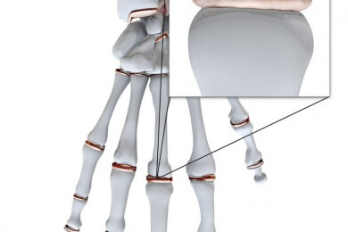 Bei Juvenile Arthritis sofort in Therapie gehen