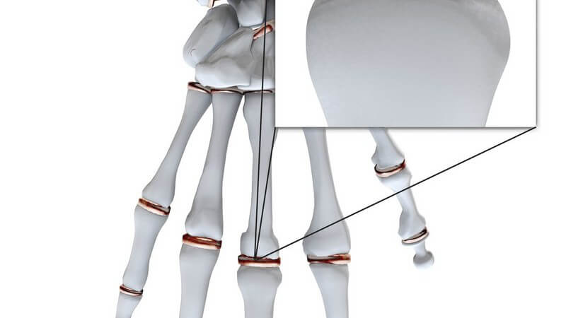 Modell Handknochen mit Nahaufnahme Handgelenk, Arthritis