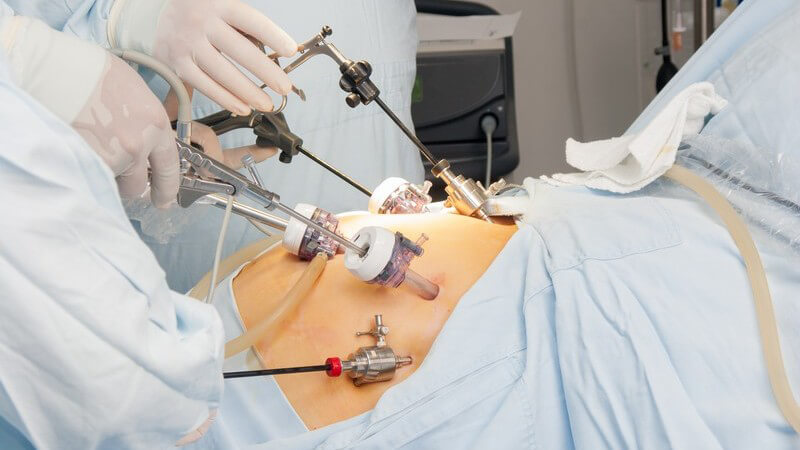 Magen-Bypass-Operation, Patient liegt auf OP-Tisch, Chirurgen halten OP-Besteck