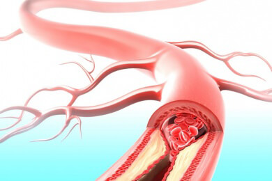 Schutz vor Thrombosen - Expertenteam in Deutschland gegründet