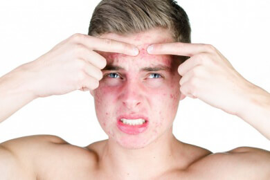 Unreine Haut ist vor allem ein Teenager-Problem