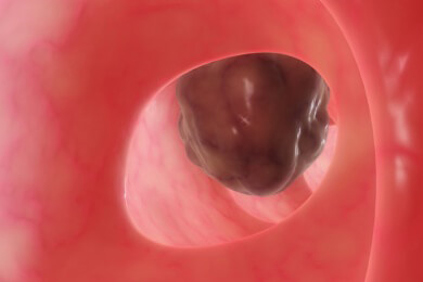 Auch eine gutartige Gewebeveränderung sollte bestrahlt werden