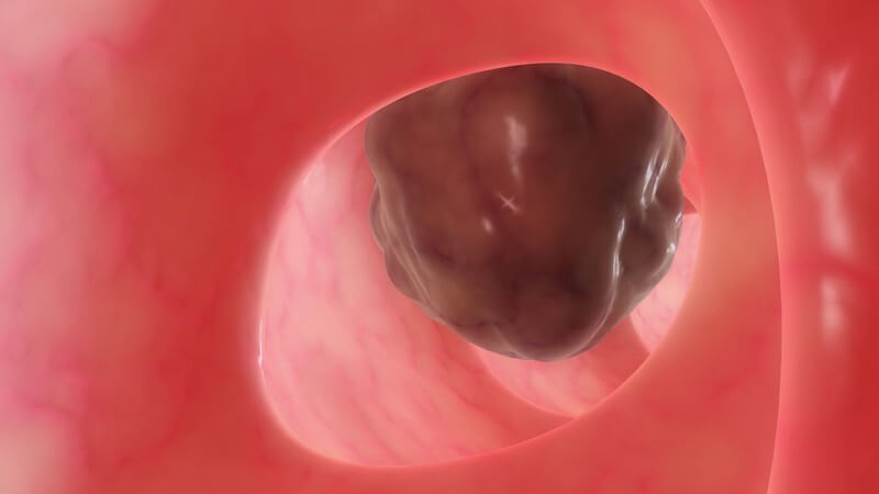 Grafik eines braunen Tumors im menschlichen Darm