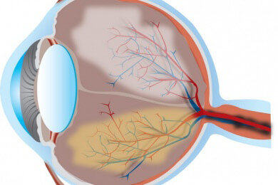 Die Lasik-Operation sollte nur am gesunden Auge angewendet werden