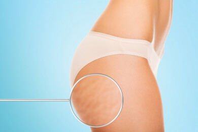 Tipps im Kampf gegen Cellulite