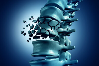 Fracture Putty Stammzellen - Gebrochene Knochen wachsen nach Tagen wieder zusammen