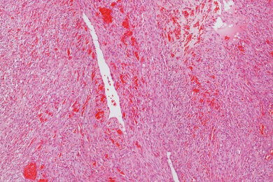Mehr Krebserkrankungen, aber auch weniger Todesfälle