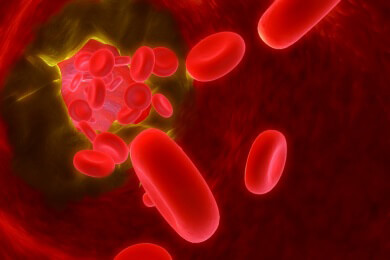 Der neue Erreger Streptococcus tigurinus