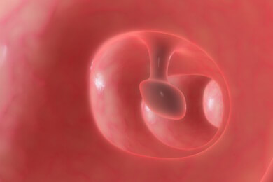 Erfolge der Polypektomie - Sterblichkeit durch Darmkrebs sinkt um 50 Prozent