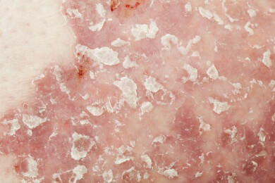 Psychodermatologie - Ärzte erforschen das Zusammenspiel zwischen Kummer und Hautkrankheiten
