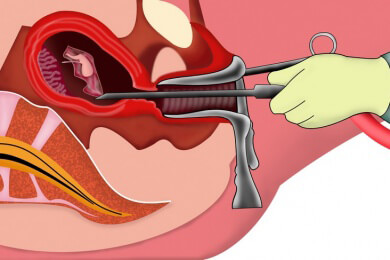 Abtreibung aufgrund des Geschlechts? Skandal in Großbritannien