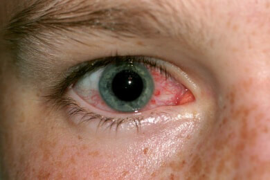 Alarmzeichen trockenes Auge: Ursachen und Gefahren