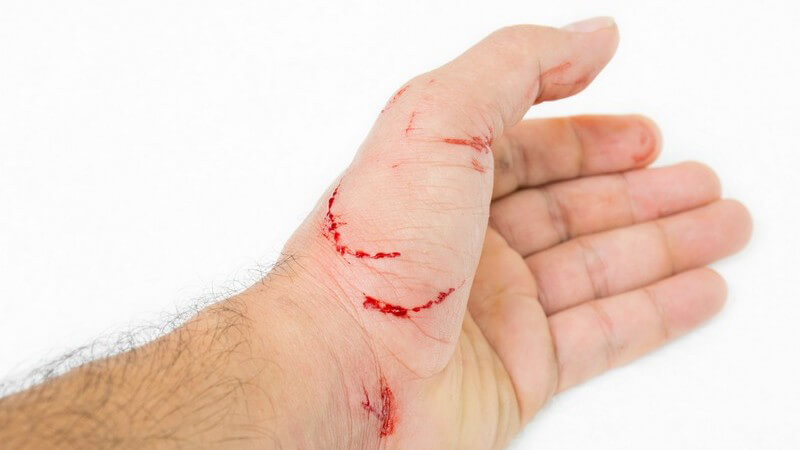 Hand mit blutenden Kratzern und Wunden von einer Katze vor weißem Hintergrund
