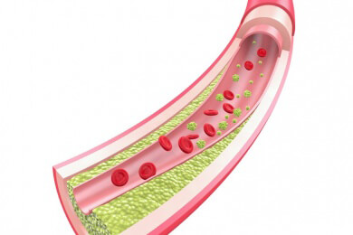 Entwicklung von künstlichen Arterien mit geringerer Verstopfungsgefahr