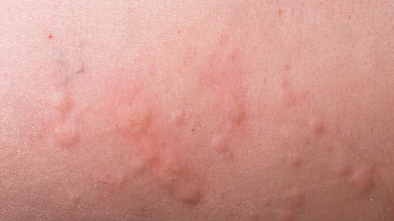 Hautausschnitt mit Ausschlag, Allergie