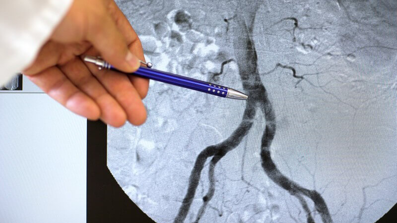 Angiografie - Ärztehand zeigt mit Kuli auf Röntgenbild von Arterie