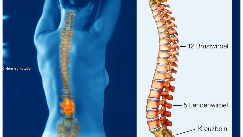 ᐅ Lumboischialgie - Können Die Schmerzhaften Wirbel Durch Steroide ...