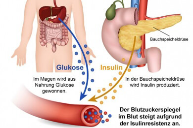 Weniger Diabetes durch die richtige Auswahl von Lebensmittel