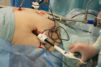 Neue Verwendungsmöglichkeit von abgesaugtem Fett - Forscher wollen daraus Blutgefäße züchten