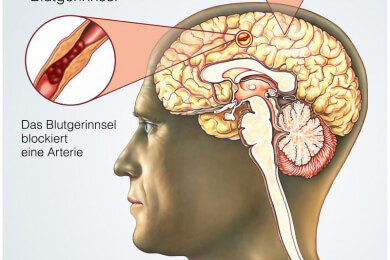 Schlaganfall-Patienten können mit Yoga ihren Gleichgewichtssinn verbessern