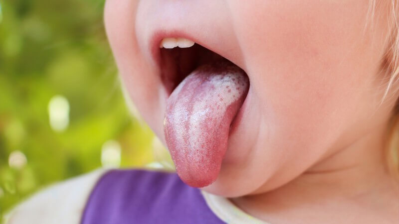Weißer Belag auf herausgestreckter Zunge eines Kleinkinds