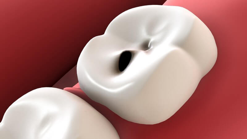 Grafik weißer Zahn mit Loch, Karies