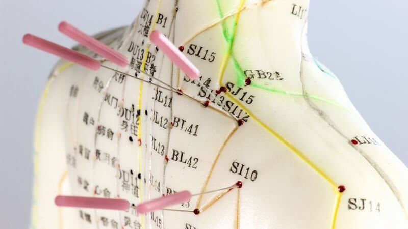 Nacken, Rücken eines Modells, Patient mit Akupunkturnadeln in Akupunkturpunkten