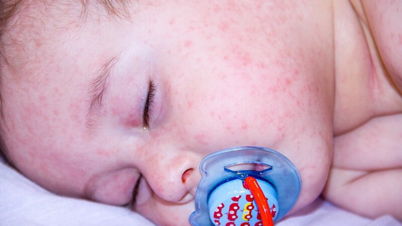 Schlafendes Baby mit blauem Schnuller hat Hautausschlag im ganzen Gesicht