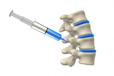 Das Ischiassyndrom lässt sich mit der Epidural-Injektion doch nicht behandeln