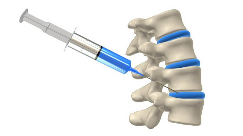 Grafik Spritze in Rückenmark oder Wirbelsäule zwischen Wirbel, PDA, Periduralanästhesie