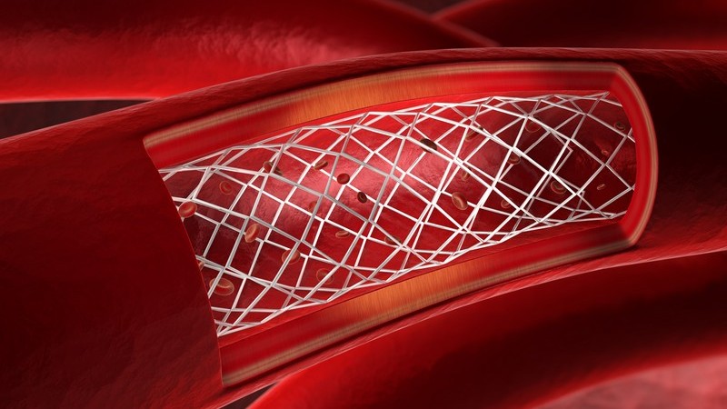 Rote 3-D-Grafik eines Blutgefäßes mit Stent
