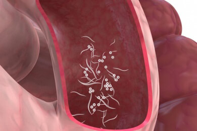 Eradikation des Medinawurms durch Mali-Konflikt
