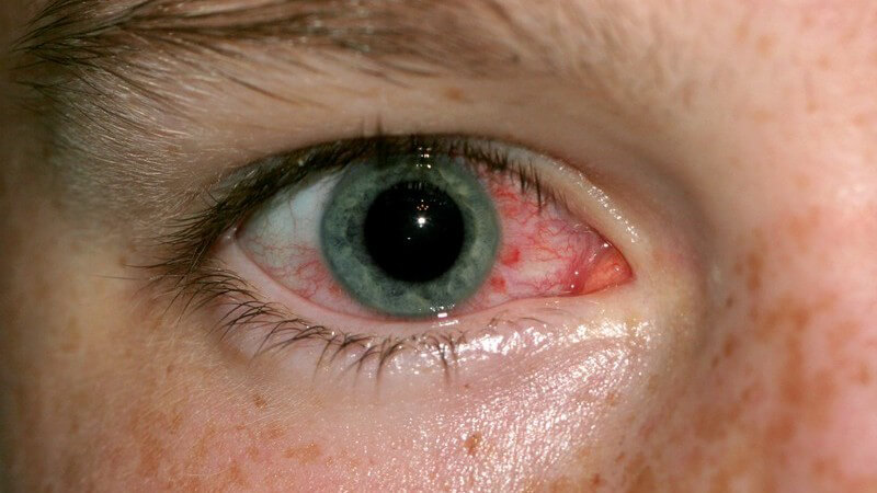 Nahaufnahme rechtes rotes Auge, Allergien