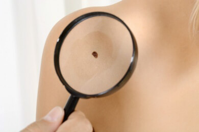 Fazit zur Krebsbekämpfung - inzwischen sind 50 Prozent der Fälle heilbar