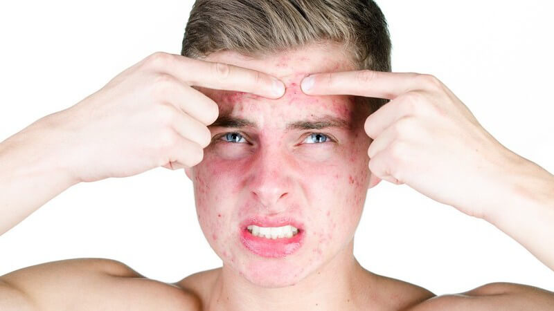 Teenager mit starker Akne drückt Pickel an Stirn aus