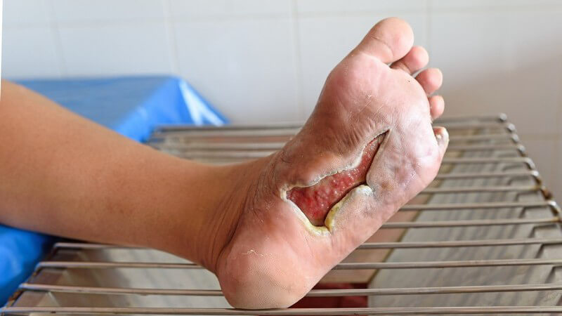 Fuß auf einem Gitter, diabetischer Fuß mit großer offener Wunde an der Fußsohle